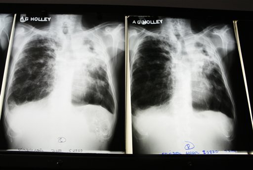 X-rays from a tuberculosis patient at A. G. Holley Hospital in Lantana, Fla. (Photo via AP)